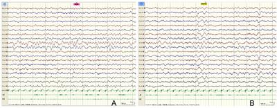 Case report: A novel de novo variant of SCN8A in a child with benign convulsions with mild gastroenteritis